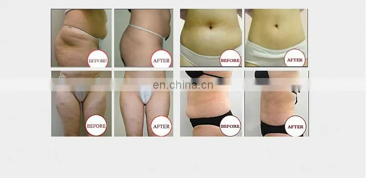 Factory price cryo double chin reducer machine slimming equipment