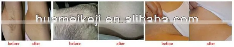 2014 hottest sale 808nm diode laser hair removal machine