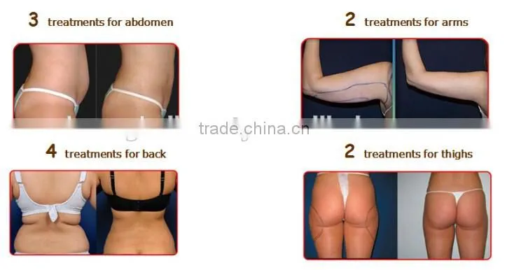 lipo laser slimming machine lipolaser machine cavi lipo laser