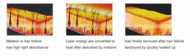 OEM wholesale Amazon! micro dermal roller DNS revo derma roller for acne scars/wrinkles/age spot/stretch mark