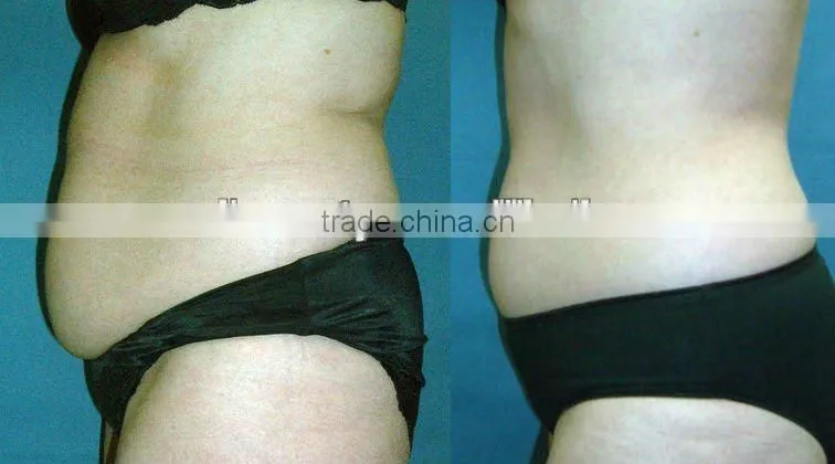 Resonable Price!! ultrasonic beauty machine to disslve the fat (FB-F017) for loss weight