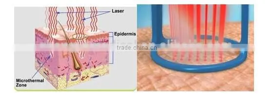 co2 fractional rf vaginal tightening co2 laser surgery machine