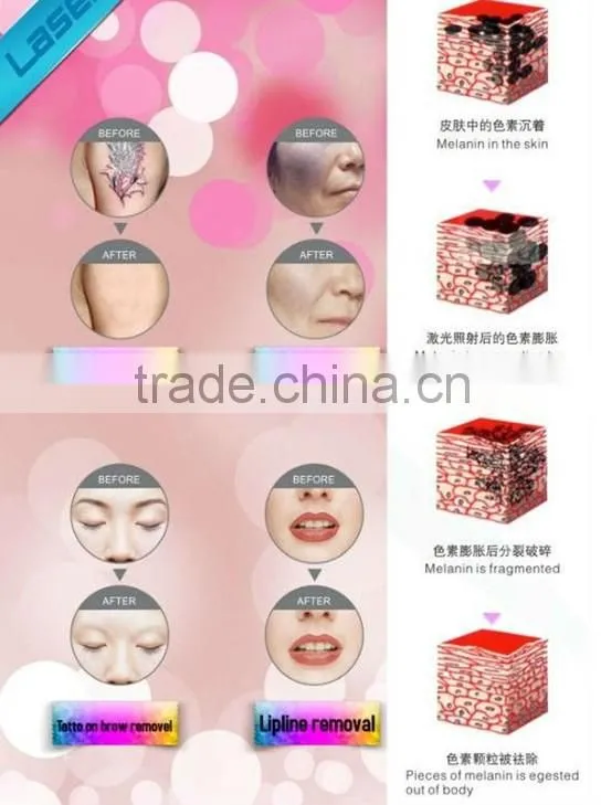 Q-switched Nd Yag Laser Mole Removal Machine/ Nd Yag Laser/Laser Tattoo Removal Machine