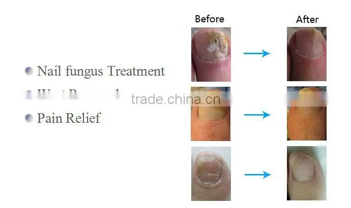 Korea Technology Portable Nail Fungus Treatment Fiber 1064nm Nd Yag Laser with Teaching Video