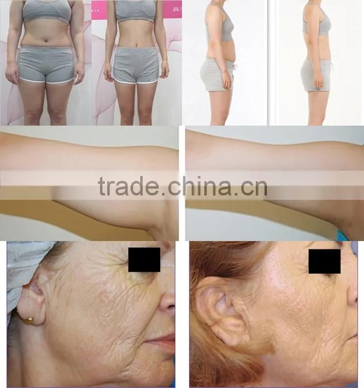 Best Beauty Equipment Lipo Laser for Weight Loss