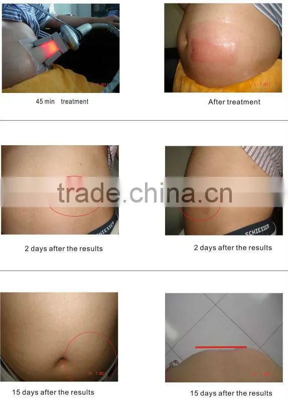 Cryolipolysis machine for sale,3 interchangeable cryo handpieces,Reduce 26% fat in the treatment area