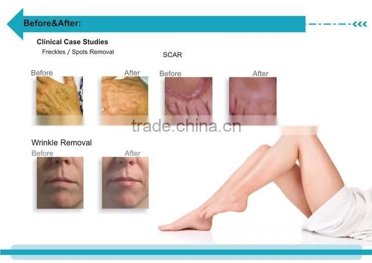 Protable Co2 fractional laser machine vaginal tighten rejuvenation Promotion price on sale boxing day price