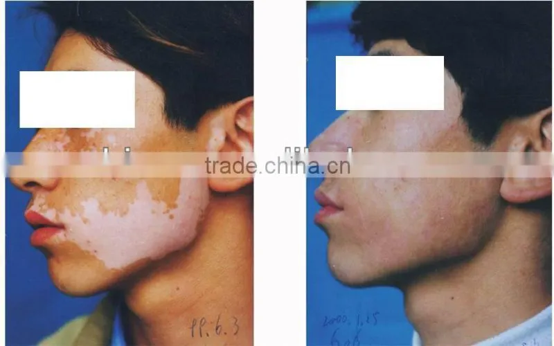epidermis transplantation vitiligo cure machine