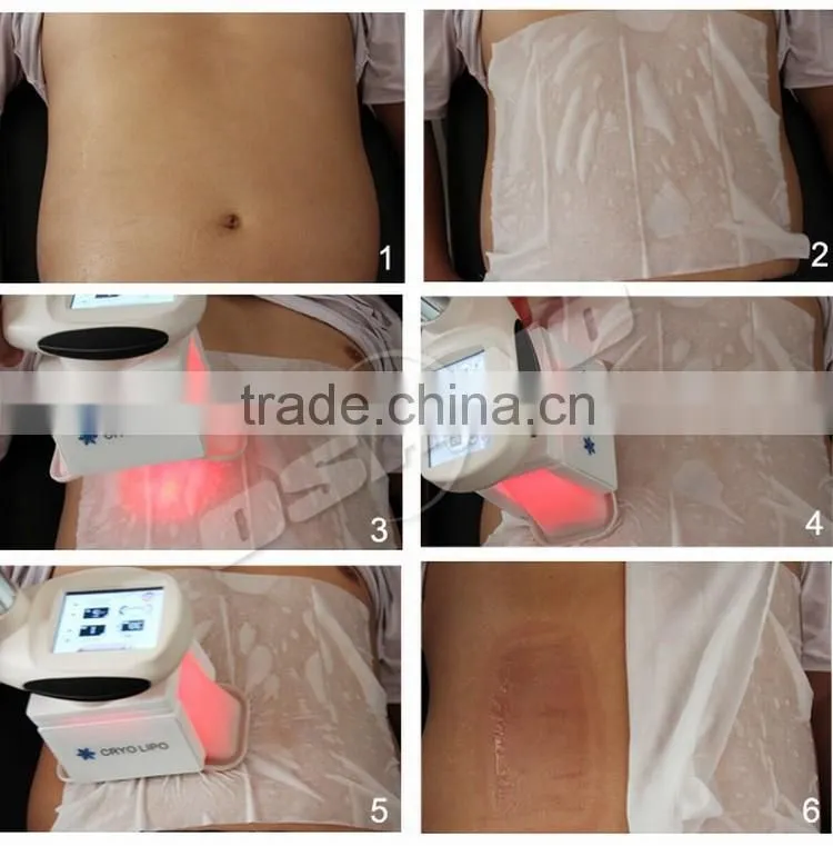 Mini Cryolipolysis For Home Use