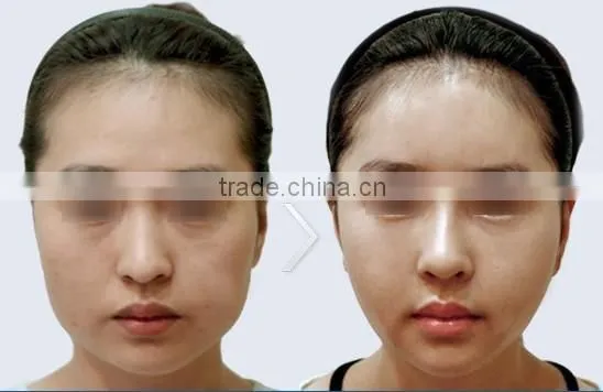 RF Face lifting machine anti-aging beauty salon use machine ZOEY