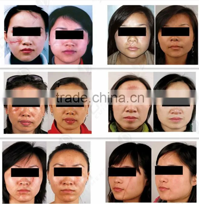 C600 New Product!! CE medical use fractional CO2 laser beauty machine
