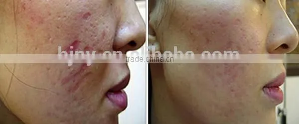 Supply Stamp 40 Pins Titanium Alloy Micro Needling Derma Roller Size