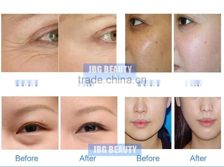 Home use Needle free Mesotherapy No Needle Nutrient Penetration Injector Beauty Machine