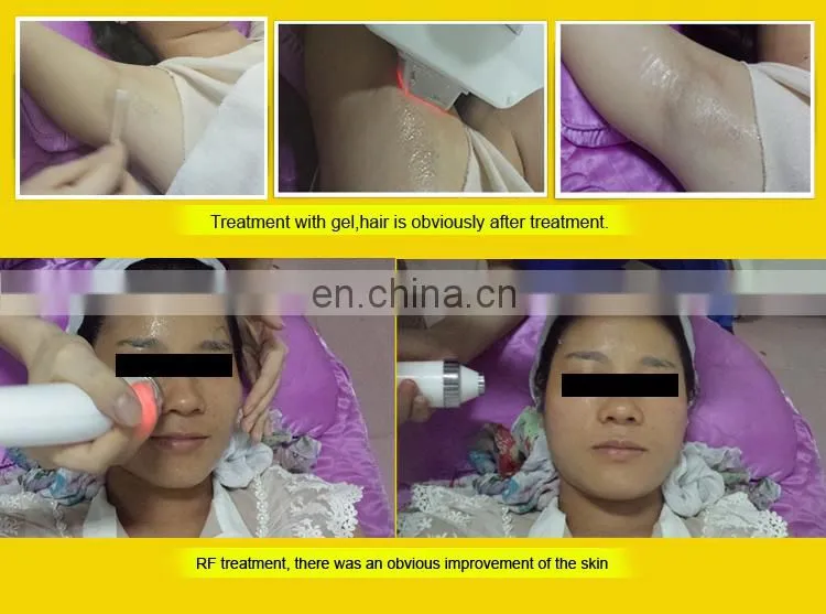 Effective Portable IPL E-light OPT Skin Rejuvenation Hair Removal Laser RF Wrinkle Removal Skin Tightening Machine