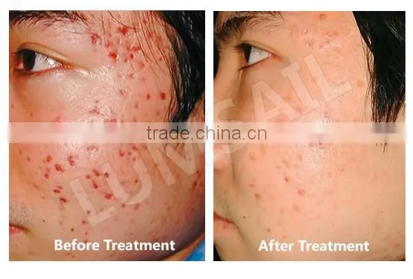 LED Phototherapy Lamp/Beauty Salon Infrared Lamp/Facial skin acne/skin tightening/skin rejuvenation/hair loss treatments