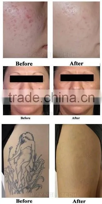 Royal-QL338 Powerful Q Switch ND YAG Laser Skin Treatment Machine