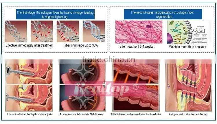 Non-surgical Co2 laser vaginal rejuvenation treatment/ fractional co2 laser vagina tightening scars acne treatment machine