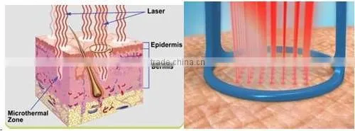 laser facial machine co2 surgical laser manufacturer