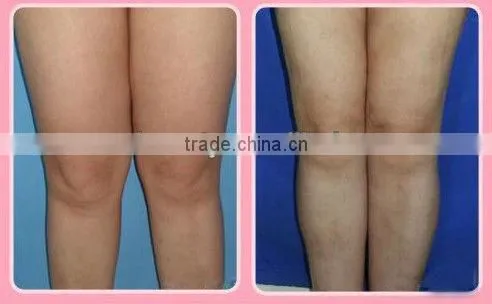 Resonable Price!! ultrasonic beauty machine to disslve the fat (FB-F017) for loss weight