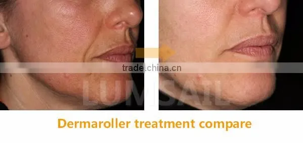 Skin care dermaroller derma roller titanium