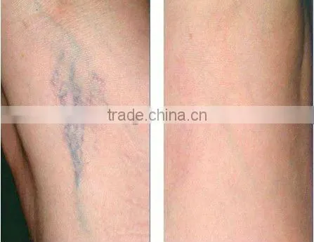 2013 new promotion! stationary hair removal laser yag laser P001