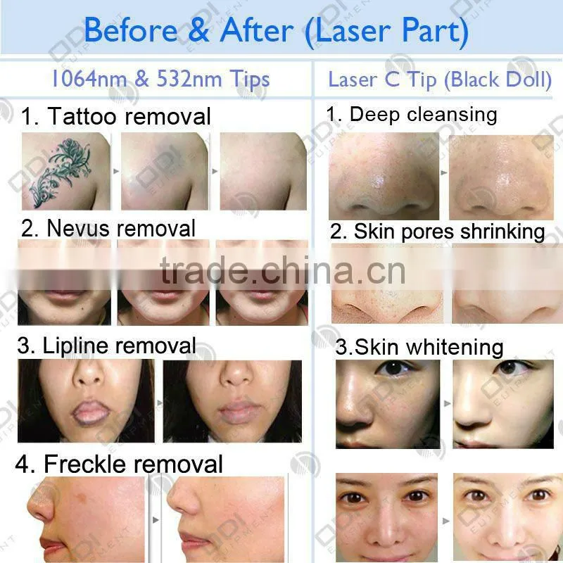 (LS600-B)Tattoo Laser: 1064nm 532nm Nd Yag Laser Tattoo Removal Machine for Beauty Salon(CE approved)