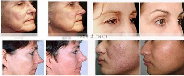 Factory direct sale! Professional skin rejuvenation/ wrinkle removal fractional rf microneedle face treatment