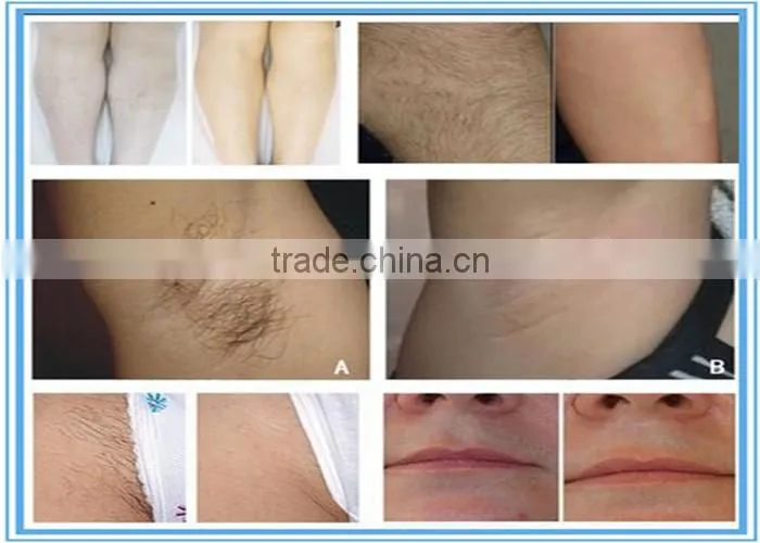 professional painless iodo laser for permanent hair removal