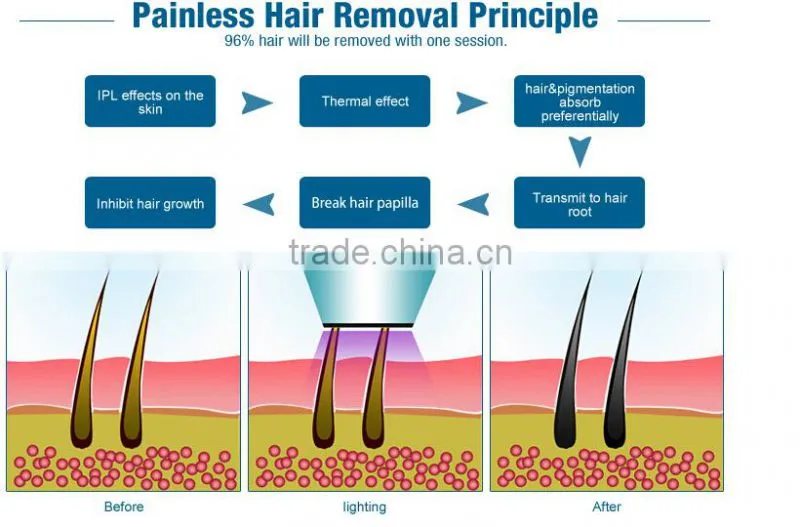 Aroma epilator laser hair removal machine diode