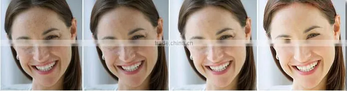High quality and inexpensive electric microneedle derma roller
