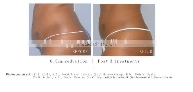 New technology professional HIFU ultrashape machine for slimming weight loss