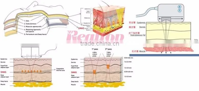 Most professional factory direct price distributor wanted ultralift hifu shaped facial skin firming ultrasonic knife machines
