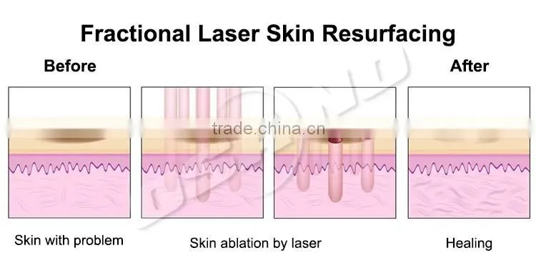 Permanent Fleckle reomval Machine Laser Tattoo Remover