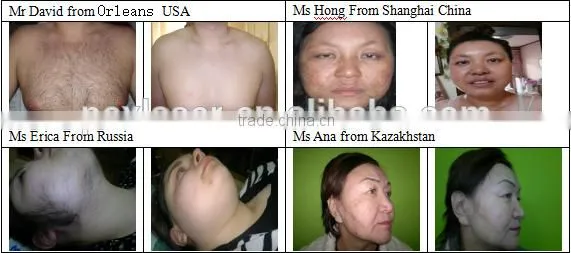 SHR supper hair removal beauty equipment for speed hair removal