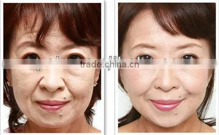 ICE RF skin rejuvenation wrinkle removal machine