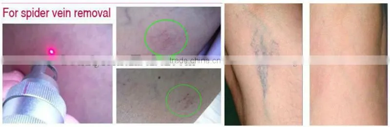 Laser epilator 2016 equipment for sale P001