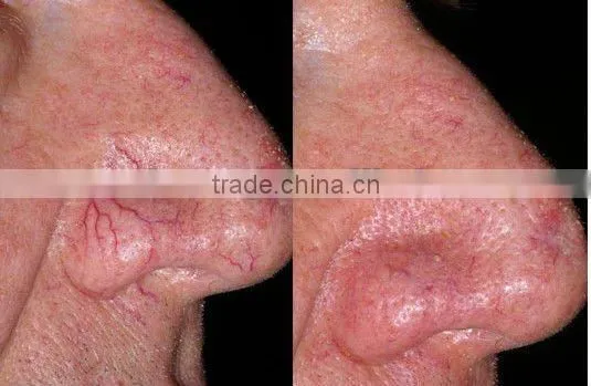 Beauty salon equipment professional long pulse laser remove hair machine-P003