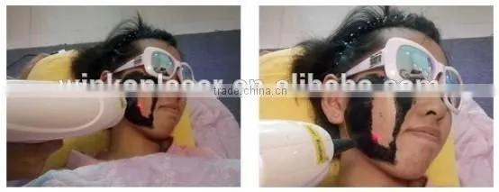 laser epilation machine / photo epilation machines