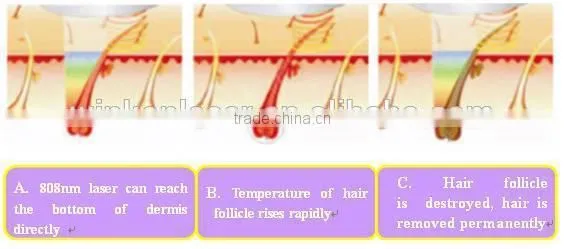 Factory price!! 2015 newest 808nm permanent hair removal for salon use