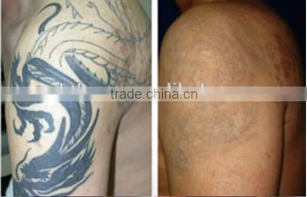 professional nd yag tattoo removal machine CE/ISO approve 1064nm,532nm can removal alll kind of color tattoo