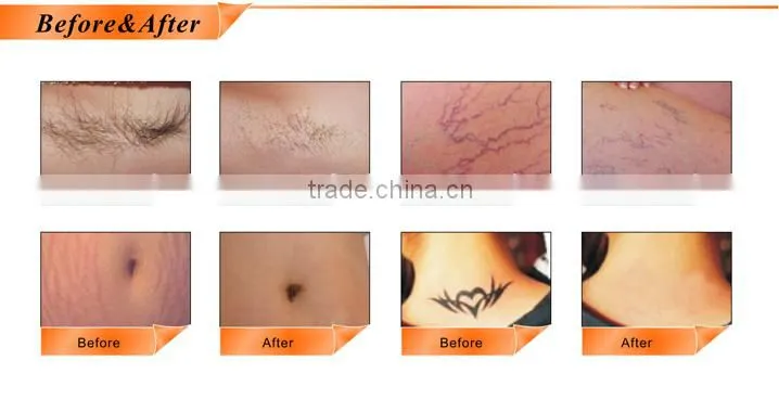 multifunctional ipl shr skin rejuvenation spider removal/nd yag laser tattoo temoval machine hair removal