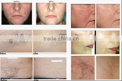 High quality hair removel,wrinkle removel,Portable IPL machine