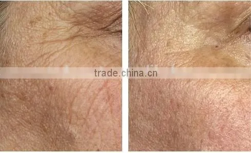 Face and Body Home IPL Hair Removal System ipl lamp with 100,000 shots