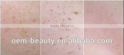 Factory direct sales !! 808nm Diode Laser+IPL diode laser hair removal with CE approved
