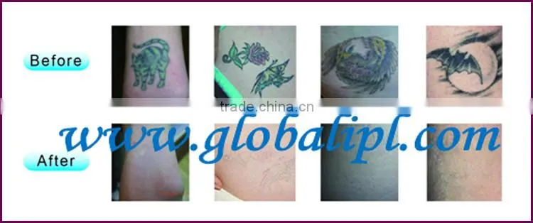 electro-optic q switch age spot pigment treatment laser with CE Approved