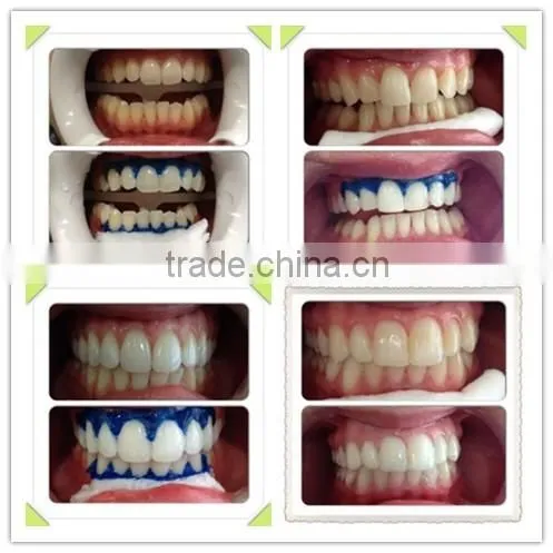 teeth whitening bleaching system gel kit
