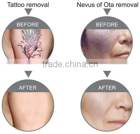 Eyebrow tattoo removal machine