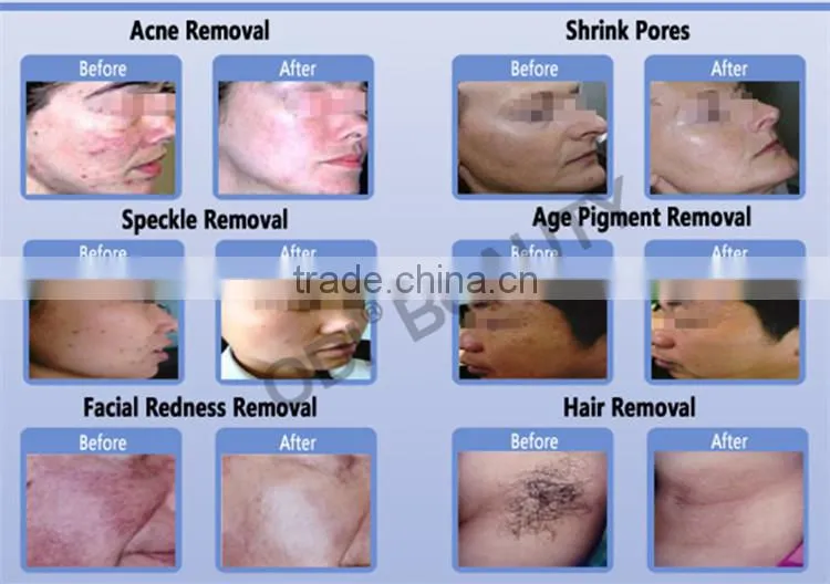 Portable ipl skin rejuvenation photofacial device for salon and home used