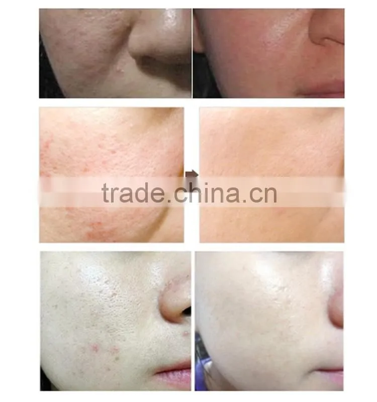 640nm Wrinkle remove led skin rejuvenation at home