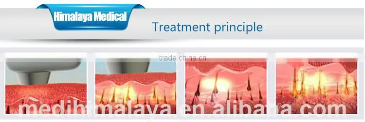 Hot selling spt cooling hair removal machine diode laser hair removal machine